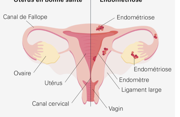 Un test salivaire pour diagnostiquer l’endométriose