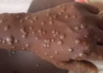 Mpox